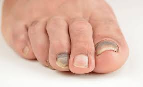 dark spots under your toenails