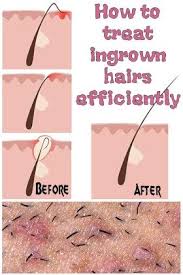 An ingrown hair near the vagina develops when the tip of a pubic hair folds back into the skin at the root. 47 Ingrown Hairs Ideas Ingrown Hair Ingrown Hair Remedies Ingrown Hair Removal