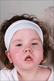 A 3-year-old girl who has global developmental delay and hypotonic...