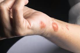 It is an aggressive method to get rid of scars, so to each there own! How To Get Rid Of Scars On Legs Home Remedies And Treatments