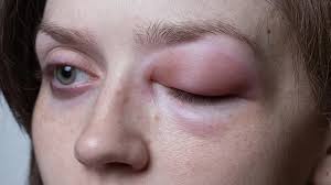 Image result for Angioedema