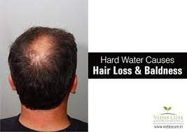 They may also clog the pores preventing new growth and damaging the roots of the hair. Vedas Cure On Twitter Does Hard Water Cause Hair Loss If Yes What Is The Treatment Or Solution Answer Https T Co Cqozqylspf