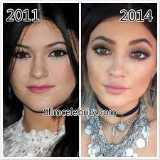 Kylie jenner plastic surgery, Kylie jenner nose job, Rhinoplasty before and  after