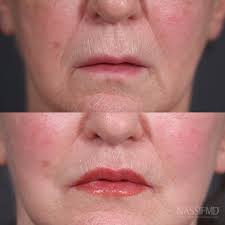 Here are the before and afters from my 68-year old lip lift patient after  only three-months! We're both already incredibly happy with her results,  and will keep you all updated! Recap: We