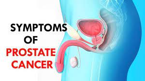 Next to skin cancer, prostate cancer is the most common cancer in american men. Signs Of Prostate Cancer Symptoms Of Prostate Cancer