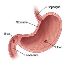 Vomiting, especially if it looks like coffee grounds and/or if blood is present, can be an indication of advanced ulcers. Peptic Ulcer