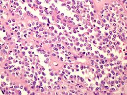 Image result for Glomus tumor
