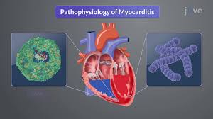 Image result for Myocarditis
