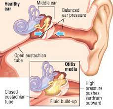 Middle Ear Infection Otitis Media Guide Causes Symptoms And Treatment Options