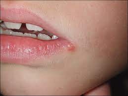 The early stages of herpes are. Herpes Simplex American Academy Of Pediatrics