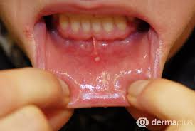 Aphten Orale Aphtose Ursachen Therapie Und Vorbeugung