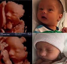 4d ultrasound pictures 36 weeks. Before And After 3d Ultrasound Images