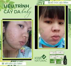 Tinh Chất Trà Xanh bản thường Kim Natural