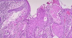 Esophageal Cancer