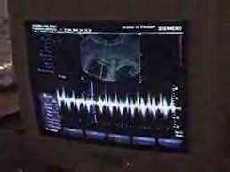 El Corazon Del Futuro Bebe Latido A Latido