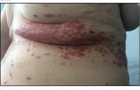 Image result for koebner phenomenon psoriasis