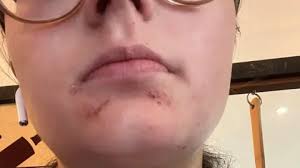 Image result for ekzema face