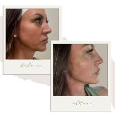 ✨ Facial Balancing ✨ This gorgeous transformation was achieved with  strategic filler placement to enhance harmony and proportion. By adding  volume to the lips, chin, cheeks, nasolabial folds, pre-jowl area, and  mid-face,