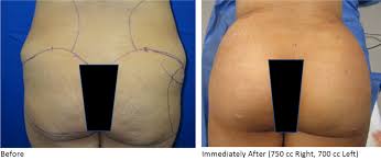 Maybe you would like to learn more about one of these? Brazilian Butt Lift Bbl In Dallas Fort Worth Tx Innovations Medical