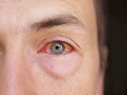 Virale bindehautentzündung des auges bei erwachsenen oder baby leicht zu identifizieren, da sie anzeichen für eine entzündung der bindehaut des auges sind identisch. Bindehautentzundung Symptome Ursachen Und Therapie Augenarzt Dr Robert Borny