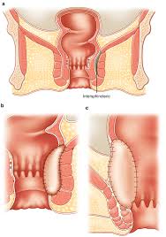 Image result for Intersphincteric Abscess