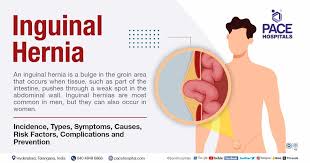 Image result for Inguinal hernia man
