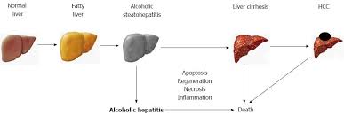 non invasive diagnosis of alcoholic liver disease