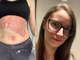 Nicole beats Staffordshire school bullies and now uses these 'miracle'  products