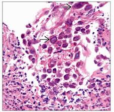 Evidenced based approach to the diagnosis and management of esophageal eosinophilia and eosinophilic esophagitis (eoe). Herpes Simplex Virus Esophagitis Basicmedical Key