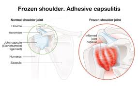 Image result for Frozen Shoulder