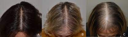 Hair loss treatment masks tend to be the most affordable option, ranging from $12 to $44. Female Androgenetic Alopecia An Update On Diagnosis And Management Springerlink