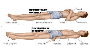 Decorticate Rigidity Abnormal Flexor Response Blogs