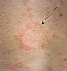 During the file restoration process using carbonite, i seem to have picked up a virus called.trashes. Pityriasis Rosea Wikipedia