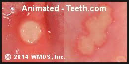Image result for Canker sores symptoms roof of the mouth