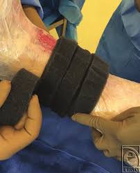 Negative Pressure Wound Therapy Was Applied To The Recipient Site Using Download Scientific Diagram