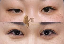Asian Blepharoplasty Double Eyelid Surgery By Vip Plastic Surgery Dr Andrew K Choi Eyelid Surgery Double Eyelid Plastic Surgery