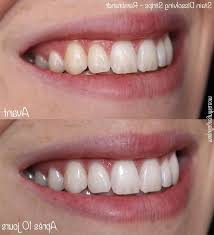 Trouvez des images de stock de charbon sur brosse à dents pour en hd et des millions d'autres photos, illustrations et images vectorielles de stock libres de droits dans la collection shutterstock. Blanchir Ses Dents Au Charbon De Bois Blanchiment Dentaire Dentiste Versailles Commencer Ou Trouver La Reference 2020