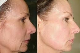 Top 5 Non-Surgical Skin Tightening Treatments in Dubai | Price & Cost