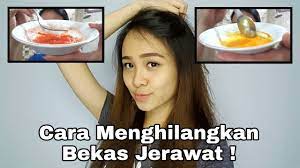 Camana i cover segala parut kalo ada parut? Cara Menghilangkan Bekas Jerawat Dengan Cepat Savira Millenita Youtube