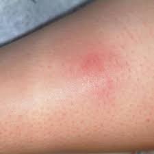 A Spider Bite That Wasn T Clinician Reviews