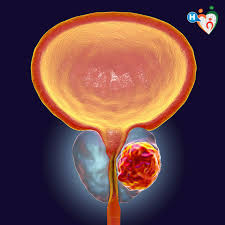 Cause di psa basso e alto. Tumore Della Prostata Sintomi Cause E Prevenzione