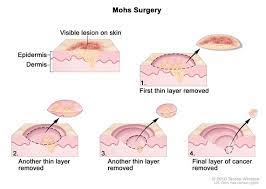 Most mohs surgeons are dermatologists who have completed extensive training in mohs surgery. Definition Of Mohs Surgery Nci Dictionary Of Cancer Terms National Cancer Institute
