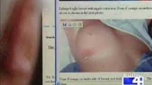 Inflammatory breast cancer may present like an infection in the breast with swelling and redness with thickening and dimpling of the skin. Breast Cancer Your Doctor Will Call A Bug Bite Kat S Musings