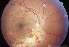 Image result for HIV Retinitis