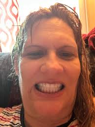 Full mouth extraction and denture placement experience