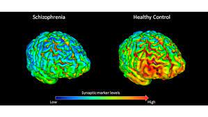 Most diseases don't differ depending on where you're from. New Study Finds Evidence For Reduced Brain Connections In Schizophrenia