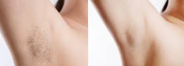 Electrolysis is a method of permanent hair removal that works on all hair and skin types. Permanent Hair Removal Sydney Cbd Clinical Electrolysis