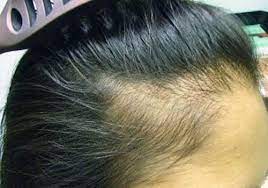 It's important to remember that healthy, strong, thick hair can only come from a healthy scalp, which is why it's a good move to opt for a shampoo made for thinning hair. Scalp Infections That Cause Hair Loss Hair Transplant Dubai