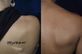 This is just water in the skin being heated up and temporarily obscuring the tattoo. How Much Does Laser Tattoo Removal Cost Rockwall Laser Tattoo Removal Juvanew Medspa