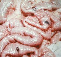 Blue Rubber Bleb Nevus Syndrome Wikiwand